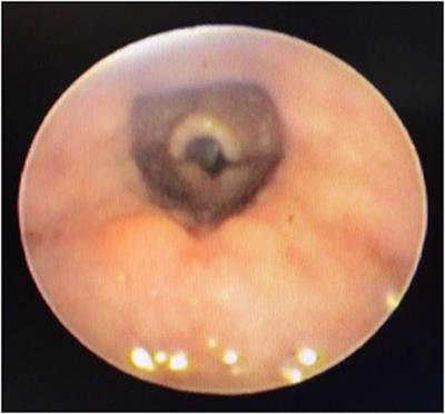 Pharyngomalacia in Neonates: The Missed Issue